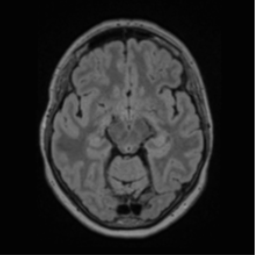 Cerebral abscess from pulmonary arteriovenous malformation (Radiopaedia 86275-102291 J 33).png