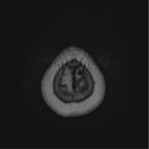 Cerebral abscess from pulmonary arteriovenous malformation (Radiopaedia 86275-102291 J 72).png