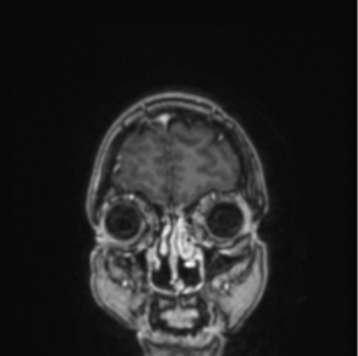 Cerebral abscess from pulmonary arteriovenous malformation (Radiopaedia 86275-102291 L 79).png