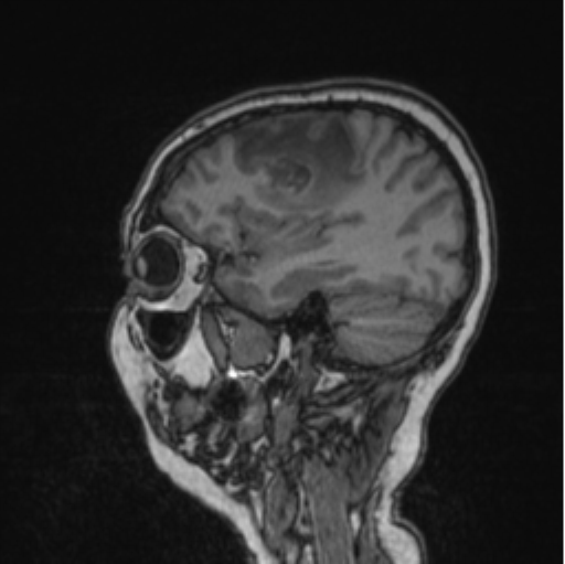 Cerebral abscess from pulmonary arteriovenous malformation (Radiopaedia 86275-102291 Sagittal T1 70).png