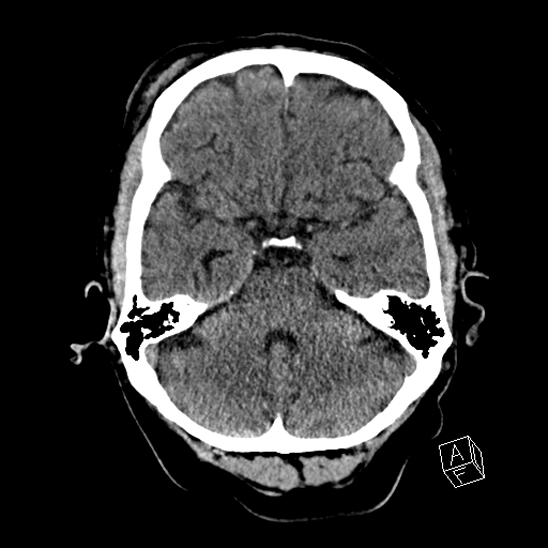 Cerebral abscess with ventriculitis (Radiopaedia 78965-91876 Axial non-contrast 17).jpg
