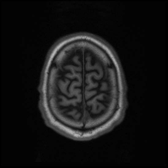 File:Cerebral abscess with ventriculitis (Radiopaedia 78965-91878 Axial T1 44).jpg