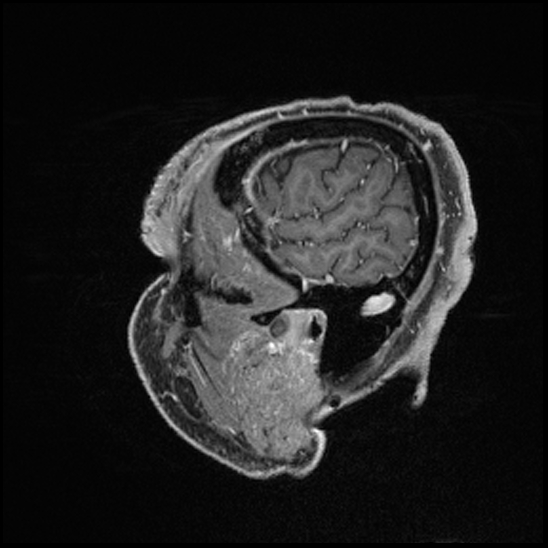 Cerebral abscess with ventriculitis (Radiopaedia 78965-91878 Sagittal T1 C+ 26).jpg