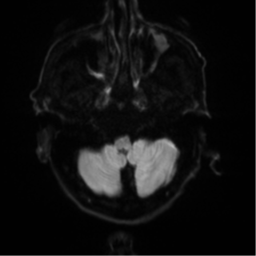 File:Cerebral amyloid angiopathy (Radiopaedia 46082-50433 Axial DWI 30).png