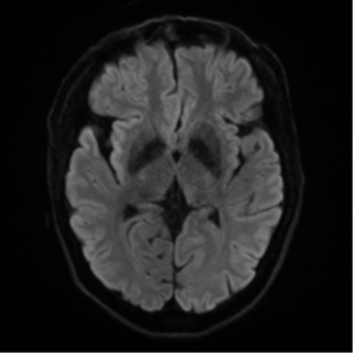 Cerebral amyloid angiopathy (Radiopaedia 46082-50433 Axial DWI 40).png