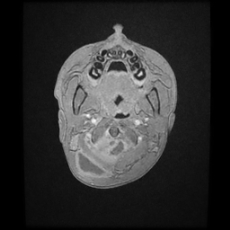 Cerebral and spinal tuberculosis (Radiopaedia 90489-107837 Axial T1 C+ 11).jpg