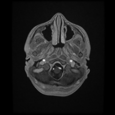 Cerebral and spinal tuberculosis (Radiopaedia 90489-107837 Axial T1 C+ 37).jpg