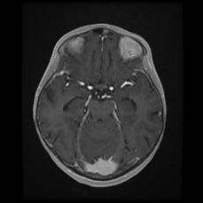 Cerebral and spinal tuberculosis (Radiopaedia 90489-107837 Axial T1 C+ 82).jpg