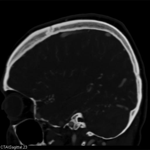 Cerebral arteriovenous malformation (Radiopaedia 28518-28759 D 20).jpg