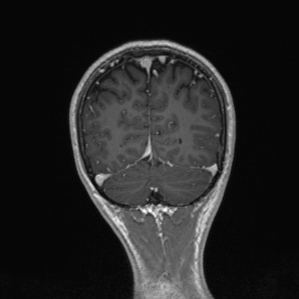Cerebral arteriovenous malformation (Radiopaedia 30198-30813 F 47).jpg