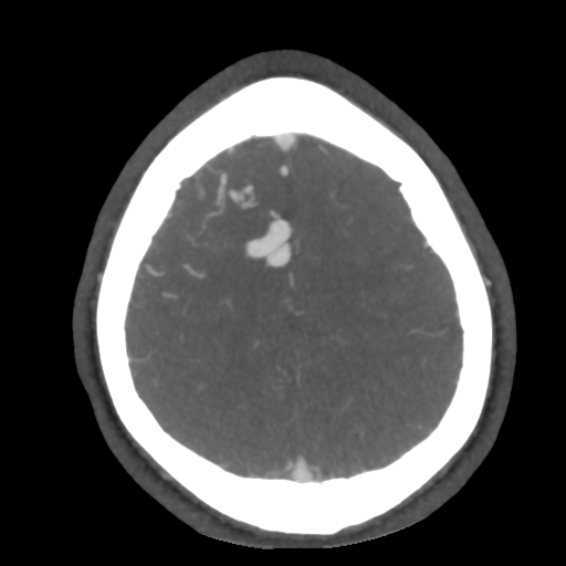 Cerebral arteriovenous malformation (Radiopaedia 39259-41505 AX CEREBRAL CTA 47).png