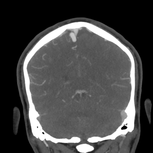 Cerebral arteriovenous malformation (Radiopaedia 39259-41505 E 47).png