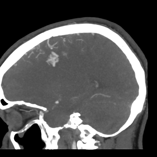 Cerebral arteriovenous malformation (Radiopaedia 39259-41505 Sagittal 22).png