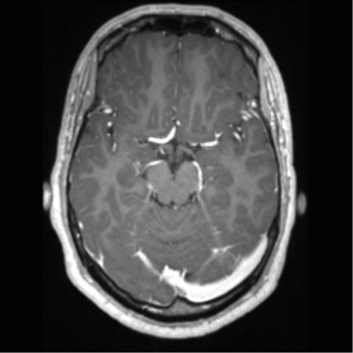 File:Cerebral arteriovenous malformation (Radiopaedia 39259-41506 AX T1 MPR C+ 27).png