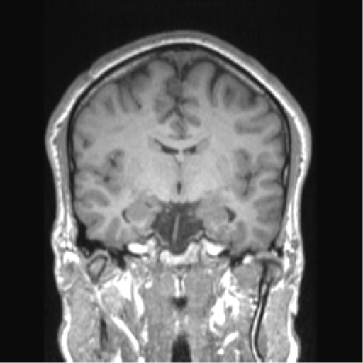 Cerebral arteriovenous malformation (Radiopaedia 39259-41506 Coronal T1 50).png