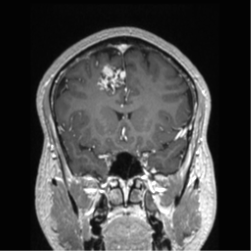 Cerebral arteriovenous malformation (Radiopaedia 39259-41506 Coronal T1 C+ 63).png