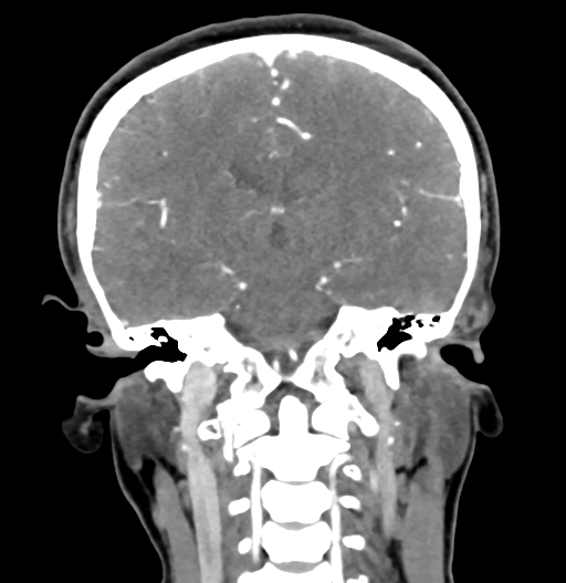 Cerebral arteriovenous malformation (Radiopaedia 73830-84645 C 56).jpg