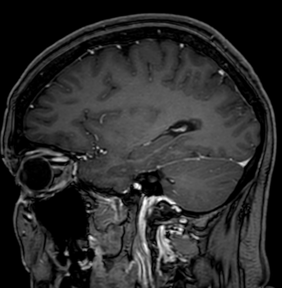 Cerebral arteriovenous malformation (Radiopaedia 74411-85746 Sagittal T1 C+ 36).jpg