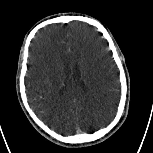 Cerebral arteriovenous malformation (Radiopaedia 78188-90746 Axial C+ delayed 107).jpg