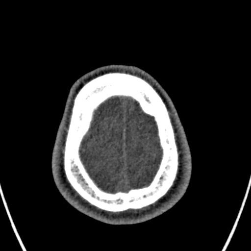 Cerebral arteriovenous malformation (Radiopaedia 78188-90746 Axial non-contrast 164).jpg