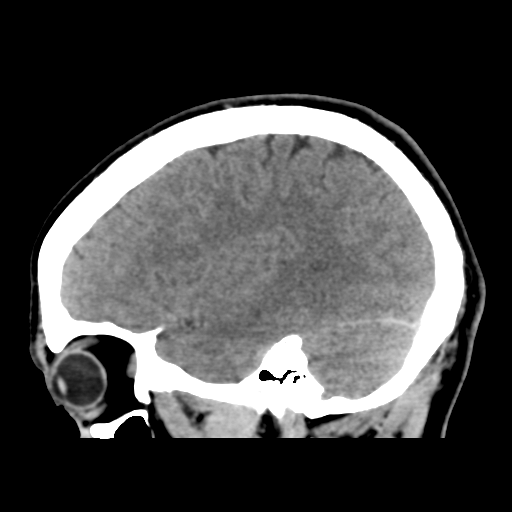 File:Cerebral arteriovenous malformation (Spetzler-Martin grade 2) (Radiopaedia 41262-44076 A 45).png