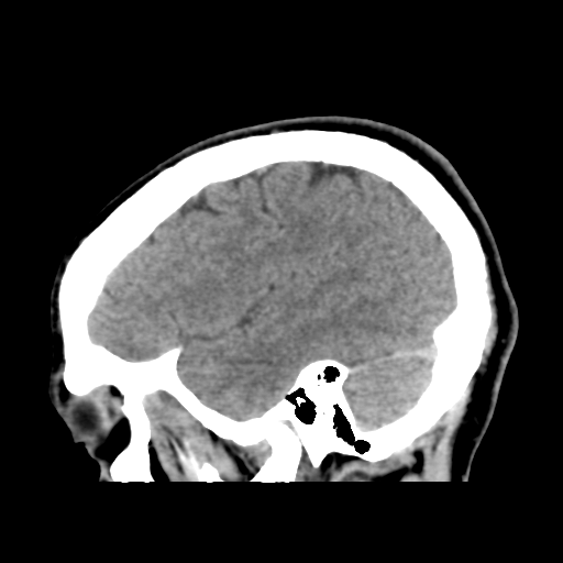 Cerebral arteriovenous malformation (Spetzler-Martin grade 2) (Radiopaedia 41262-44076 A 48).png