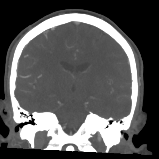 Cerebral arteriovenous malformation (Spetzler-Martin grade 2) (Radiopaedia 41262-44076 F 34).png