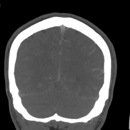 Cerebral arteriovenous malformation (Spetzler-Martin grade 2) (Radiopaedia 41262-44076 F 51).png