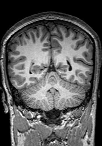 Cerebral arteriovenous malformation at posterior body of corpus callosum (Radiopaedia 74111-84925 Coronal T1 244).jpg