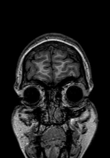 Cerebral arteriovenous malformation at posterior body of corpus callosum (Radiopaedia 74111-84925 Coronal T1 6).jpg