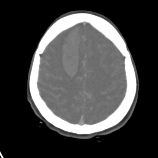 Cerebral arteriovenous malformation with hemorrhage (Radiopaedia 28773-29073 A 14).jpg