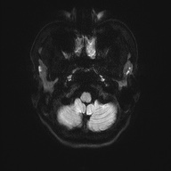 Cerebral cavernous venous malformation (Radiopaedia 70008-80021 Axial DWI 33).jpg