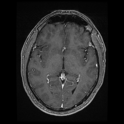 Cerebral cavernous venous malformation (Zabramski type II) (Radiopaedia 85511-101198 Axial T1 C+ fat sat 46).jpg