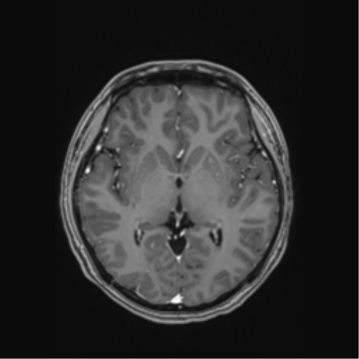 Cerebral cavernous venous malformations (Radiopaedia 48117-52946 Axial T1 C+ 29).png