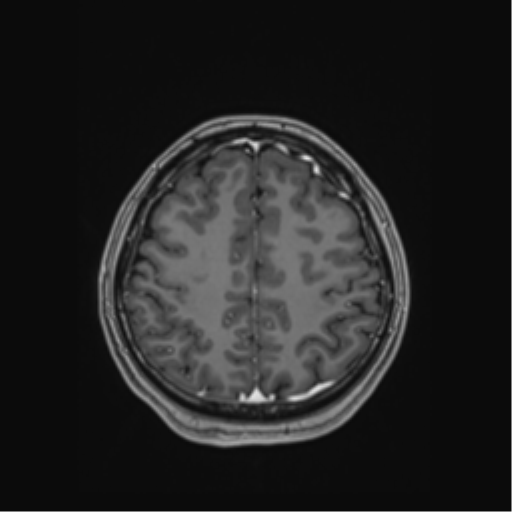 Cerebral cavernous venous malformations (Radiopaedia 48117-52946 Axial T1 C+ 48).png