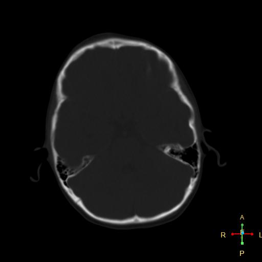 File:Cerebral contusion (Radiopaedia 48869-53911 Axial bone window 15).jpg