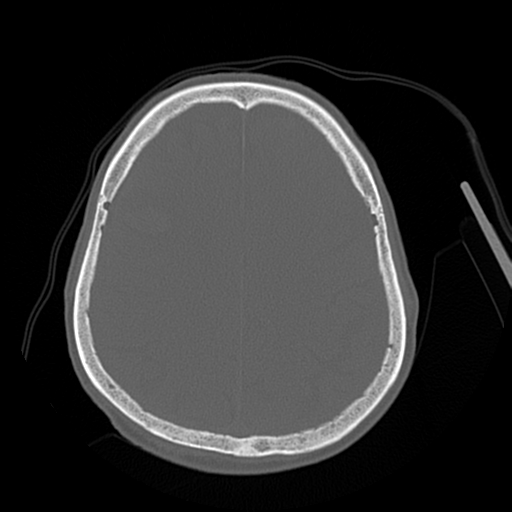 Cerebral contusions, subarachnoid hemorrhage and subdural hygromas (Radiopaedia 55399-61827 Axial bone window 37).png