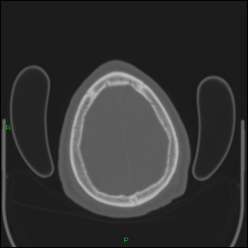Cerebral contusions (Radiopaedia 33868-35039 Axial bone window 194).jpg
