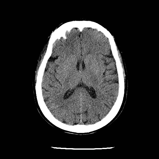 File:Cerebral edema (evolution in time) (Radiopaedia 19418-19441 non-contrast 57).jpg