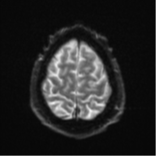 File:Cerebral embolic infarcts (embolic shower) (Radiopaedia 57395-64342 Axial DWI 31).png