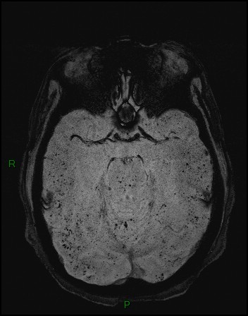 Cerebral fat embolism (Radiopaedia 35022-36525 Axial SWI 4).jpg
