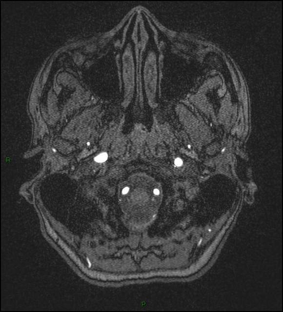 Cerebral fat embolism (Radiopaedia 35022-36525 Axial TOF 8).jpg