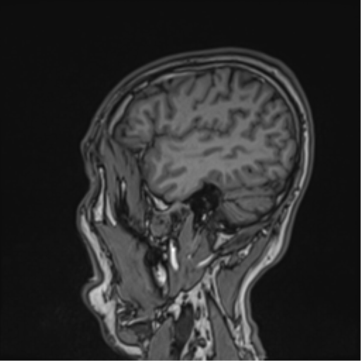 Cerebral fat embolism (Radiopaedia 57697-64639 Sagittal T1 15).png