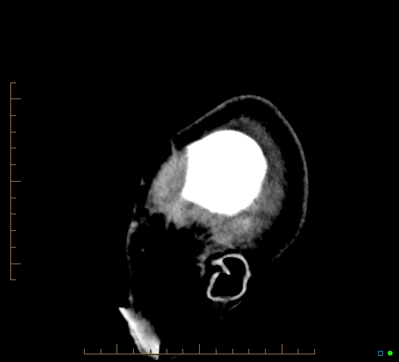 Cerebral fat embolism (Radiopaedia 85521-101224 C 2).jpg