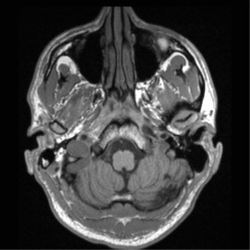Cerebral hemorrhagic contusions- temporal evolution (Radiopaedia 40224-42757 Axial T1 12).png