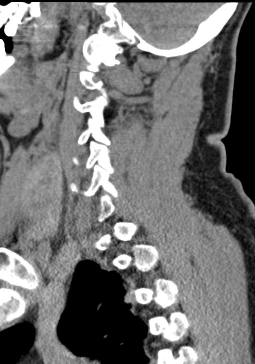 Cerebral hemorrhagic contusions and cervical spine fractures (Radiopaedia 32865-33841 G 76).jpg