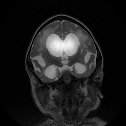 File:Cerebral manifestations of mucopolysaccharidosis type I (Radiopaedia 59171-66487 Coronal T2 10).jpg