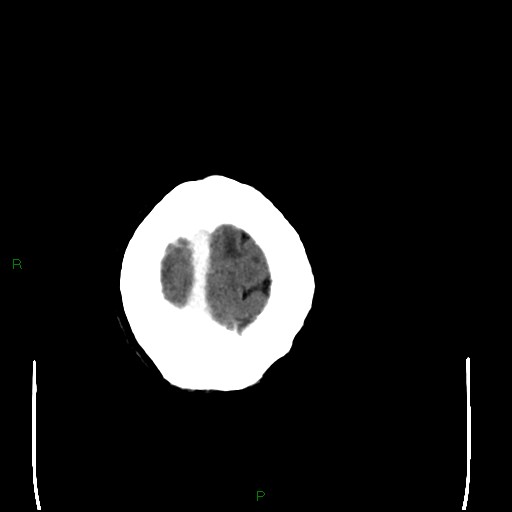 Cerebral metastases - breast primary (Radiopaedia 77653-89857 Axial C+ delayed 110).jpg