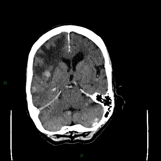 Cerebral metastases - breast primary (Radiopaedia 77653-89857 Axial C+ delayed 46).jpg