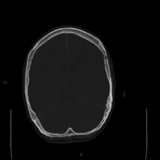 Cerebral metastases - breast primary (Radiopaedia 77653-89857 Axial bone window 58).jpg